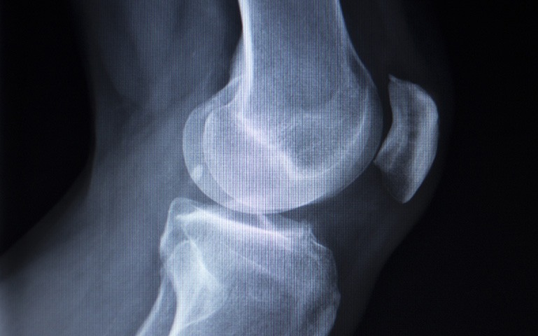 Cementless Joint Replacement
